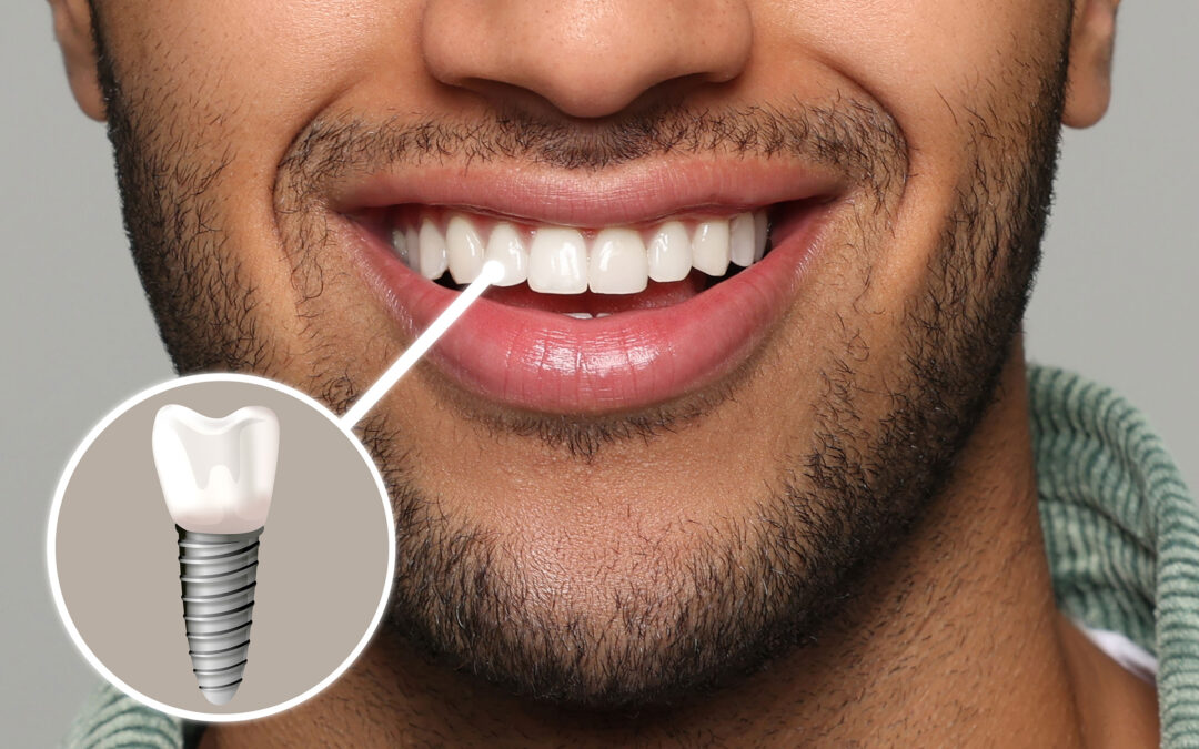 Dental Implants Q & A