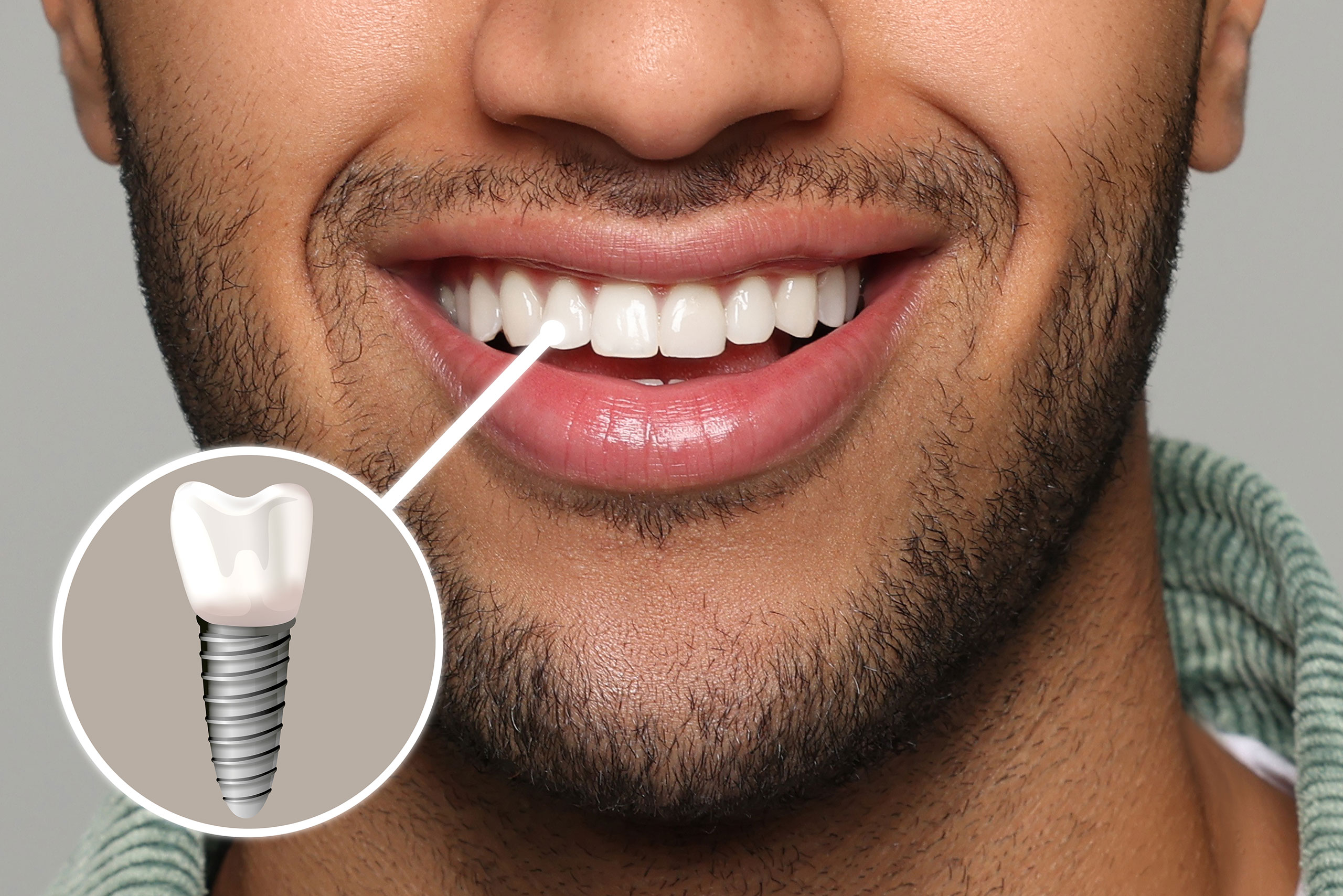 Close-up of a smiling man showing teeth with a diagram highlighting a dental implant in the front tooth area.