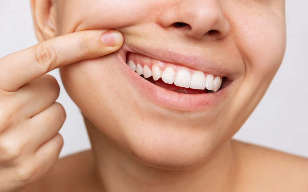 Treating Gum Recession